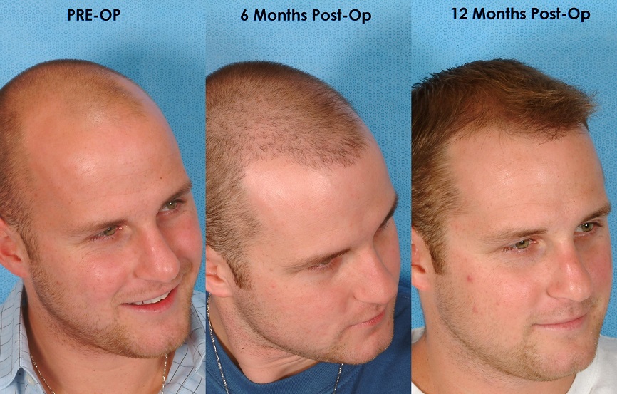 How to Check Hair Transplant Result before going for hair transplant surgery