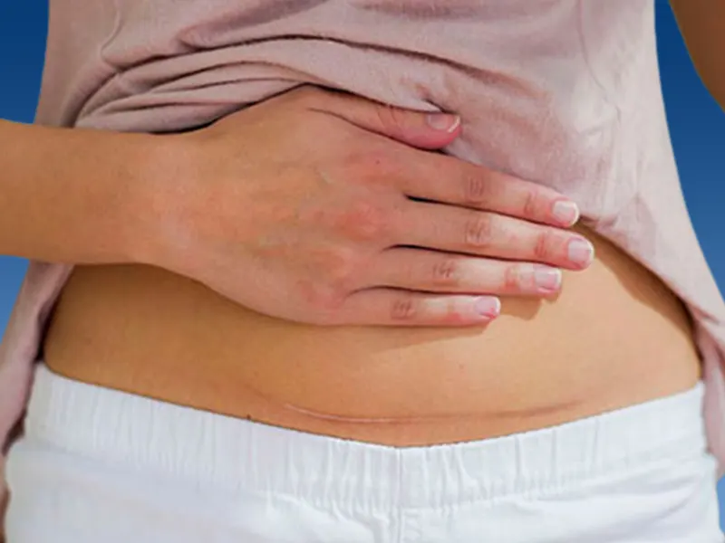 ابدومینوپلاستی