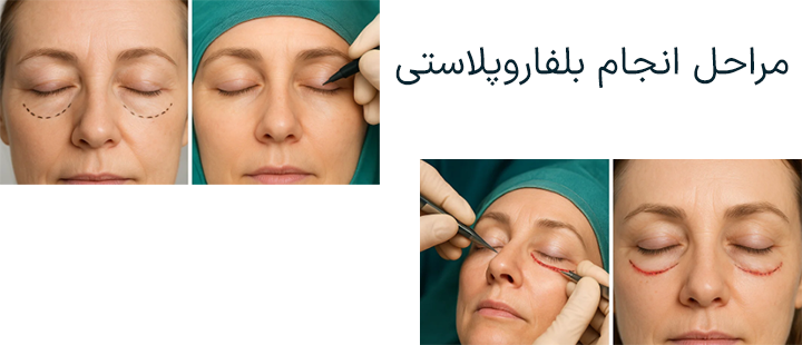 مراحل انجام بلفاروپلاستی