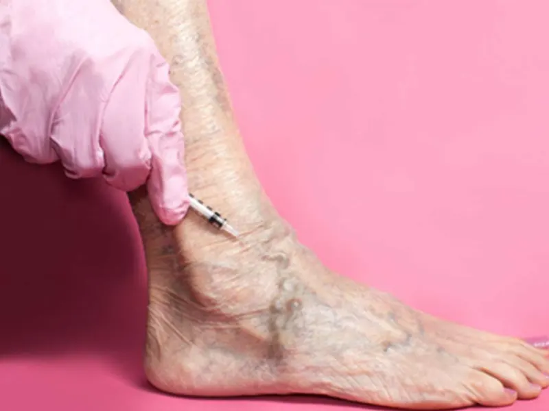 وریدهای عنکبوتی