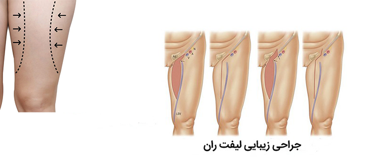 درباره لیفت ران 