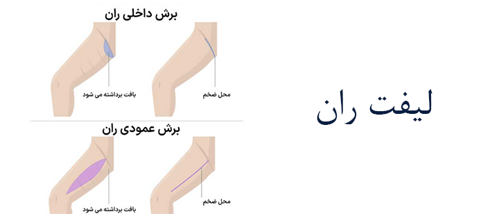 لیفت ران
