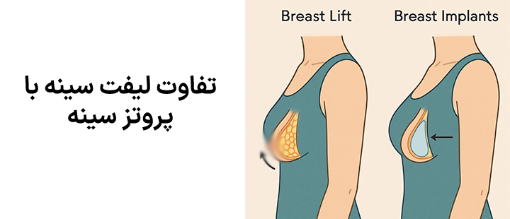 تفاوت لیفت سینه با پروتز سینه