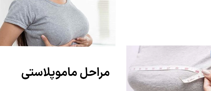 مراحل ماموپلاستی