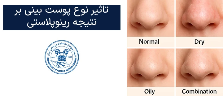 تاثیر نوع بینی بر نتیجه رینوپلاستی