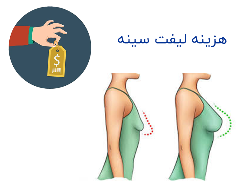 هزینه لیفت سینه