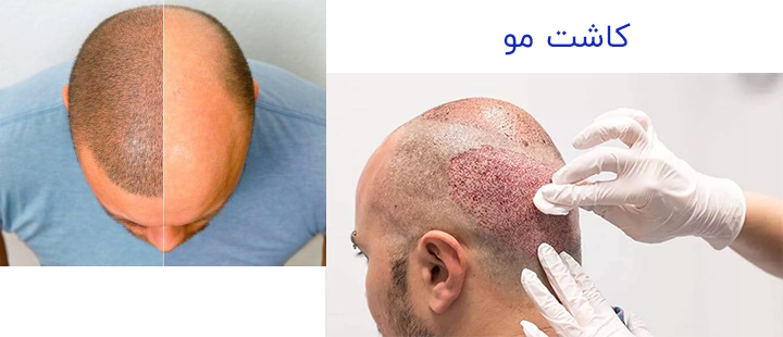 کاشت مو 