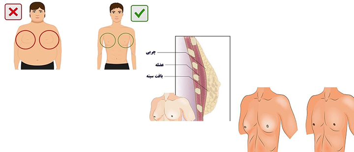 ژنیکوماستی چیست؟