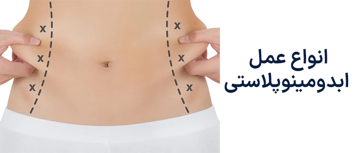 انواع عمل ابدومینوپلاستی
