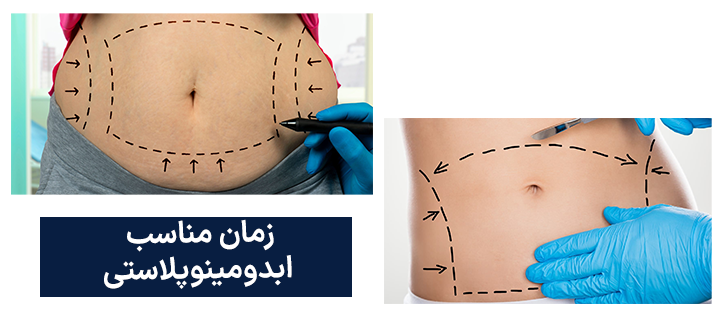 زمان مناسب ابدومینوپلاستی