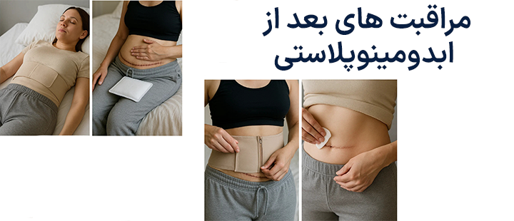 مراقبت های بعد از ابدومینوپلاستی