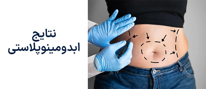 نتایج ابدومینوپلاستی