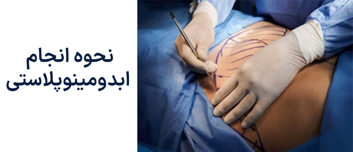 نحوه انجام ابدومینوپلاستی