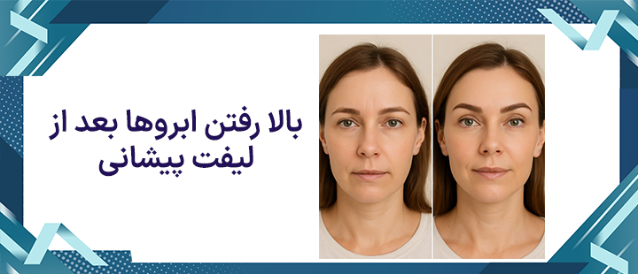 بالا رفتن ابروها بعد از لیفت پیشانی