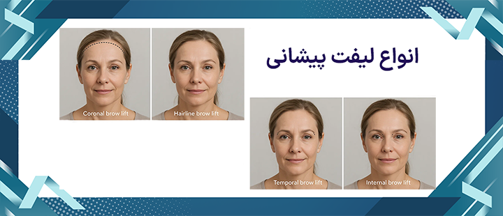 لیفت پیشانی چه انواعی دارد؟