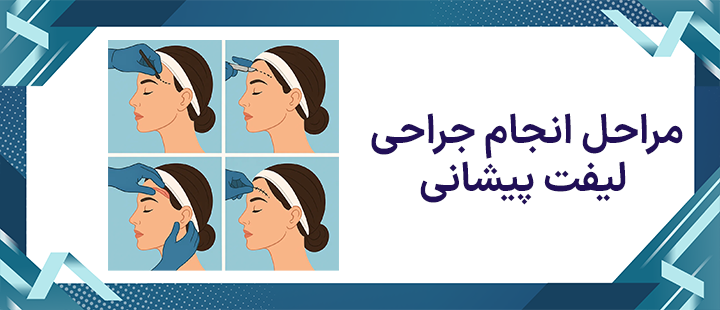 مراحل انجام جراحی لیفت پیشانی